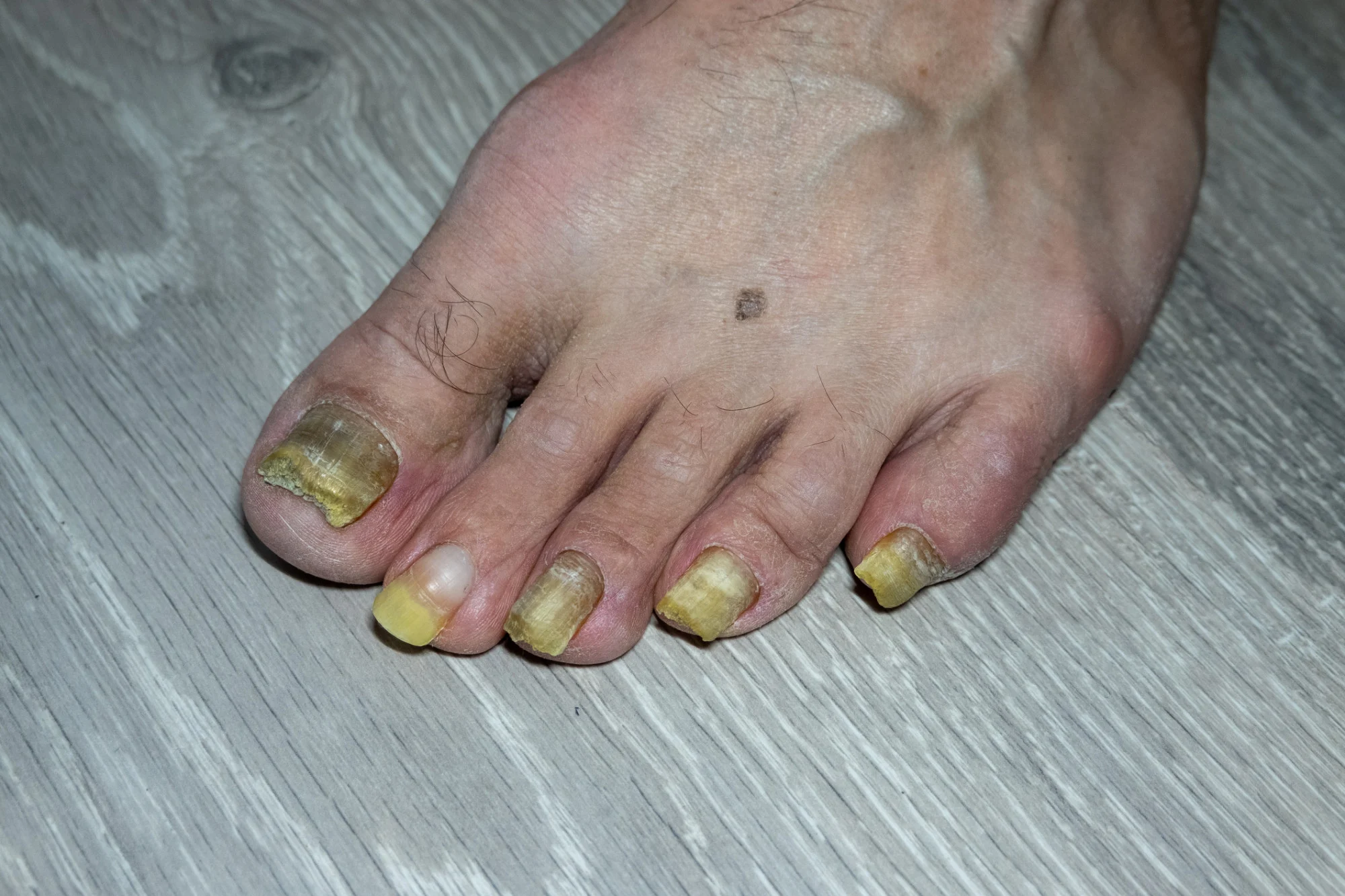 Fungus on toenail