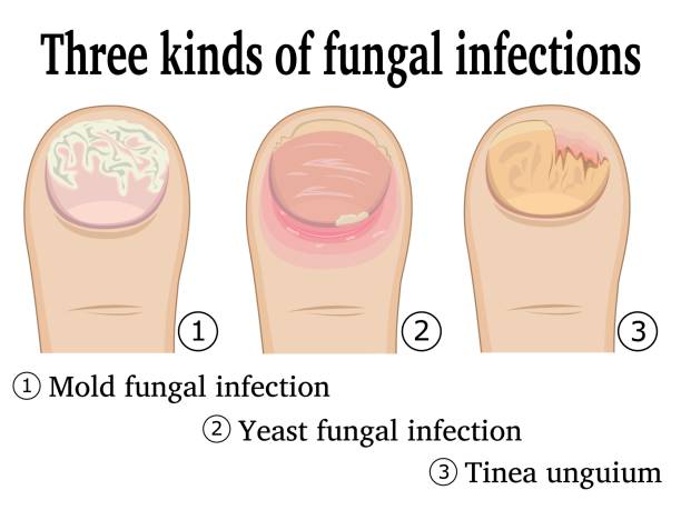 Types of nail fungal infections